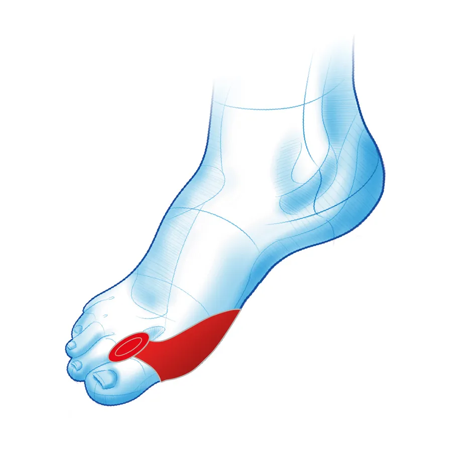 Klin między palce na haluksa z osłoną PROHALUKS DUO